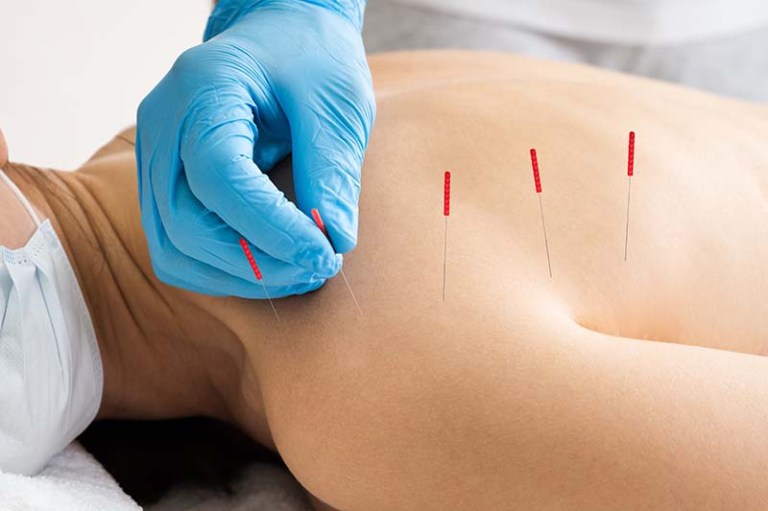 dryneedling-8159